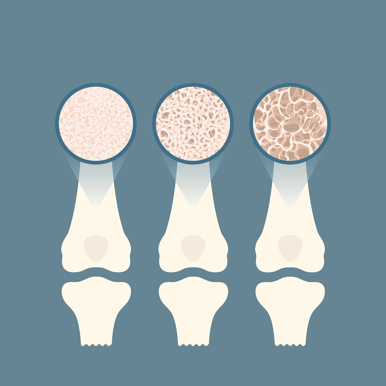 A diagram showing cells of varying levels of bone health