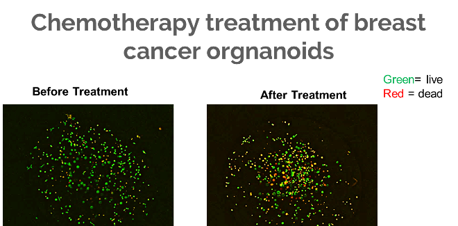 Chemotherapy treatment of breast cancer organoids