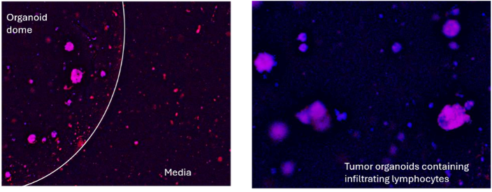 Tumor organoids containing infiltrating lymphocytes
