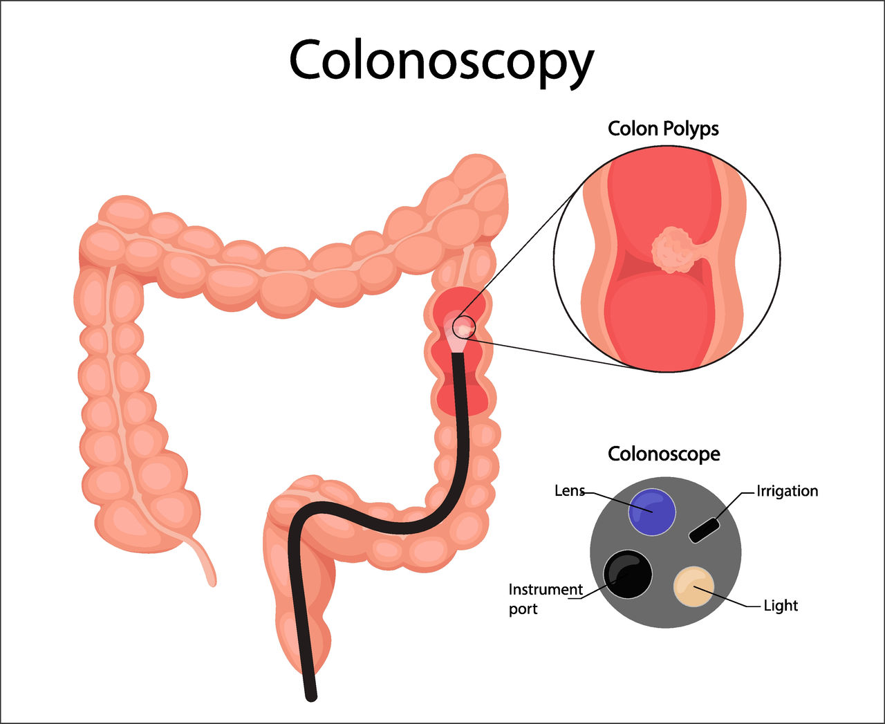A diagram of a colonoscopy and colonoscope